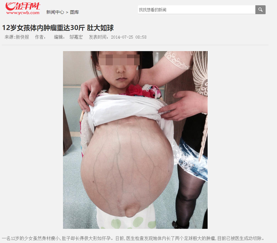 但是通过搜索发现，其实这张照片配图出自2014年7月的一则女孩患肿瘤的报道。